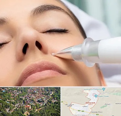 پلاسما جت بینی در دماوند