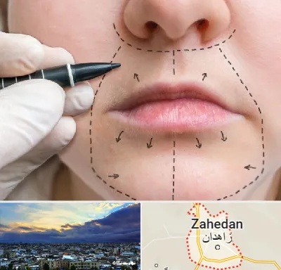 عمل سانترال لب در زاهدان