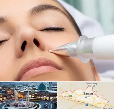 پلاسما جت بینی در زنجان