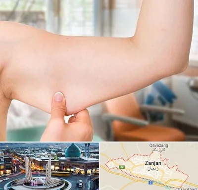 براکیوپلاستی در زنجان