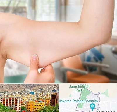 براکیوپلاستی در نیاوران 