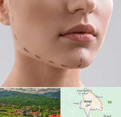 عمل زاویه فک در آمل