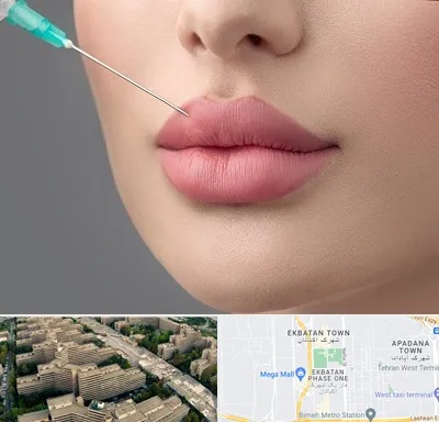 کلینیک ژل لب روسی در اکباتان 