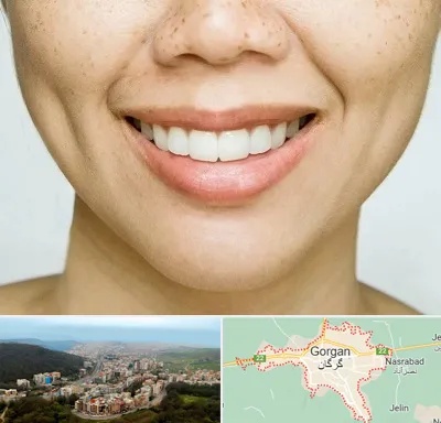 عمل چال گونه در گرگان