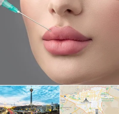کلینیک ژل لب روسی در تهران