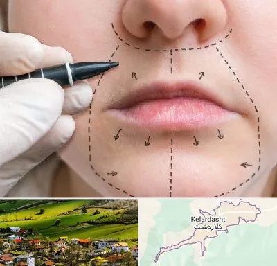 عمل سانترال لب در کلاردشت