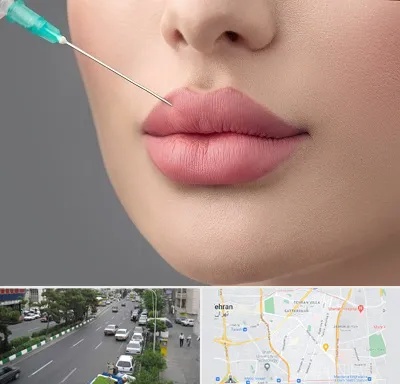کلینیک ژل لب روسی در ستارخان 