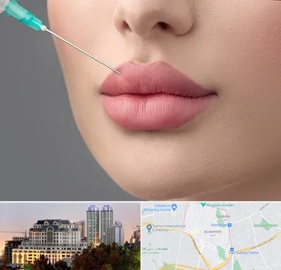 کلینیک ژل لب روسی در فرشته 