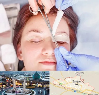 جراحی پلک افتاده در زنجان