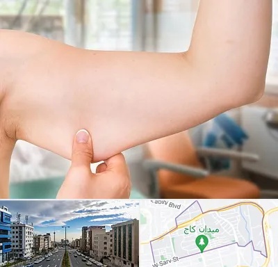 براکیوپلاستی در سعادت آباد 