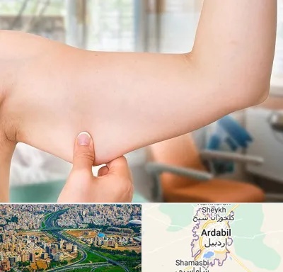 براکیوپلاستی در اردبیل