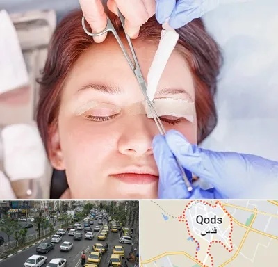 جراحی پلک افتاده در شهر قدس