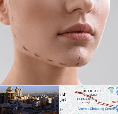 عمل زاویه فک در فرمانیه 